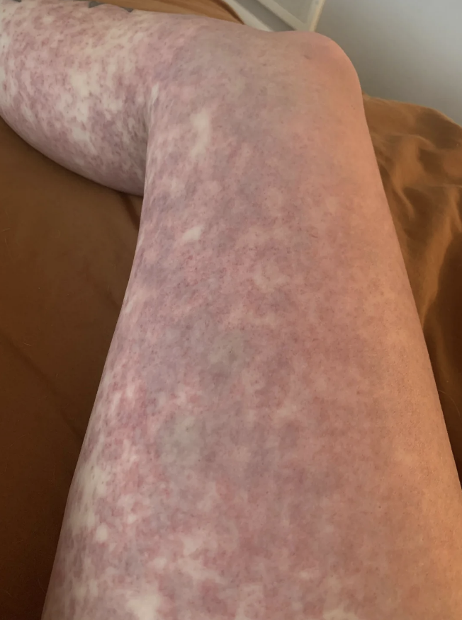 The image shows a close-up of a person&#x27;s leg with a mottled, blotchy skin condition