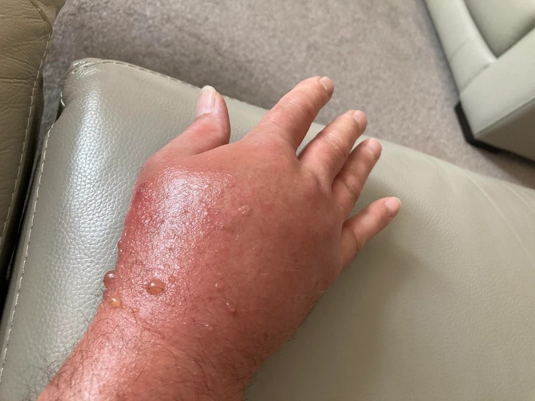 A swollen hand with blisters and redness resting on a light-colored surface, possibly due to a burn or allergic reaction