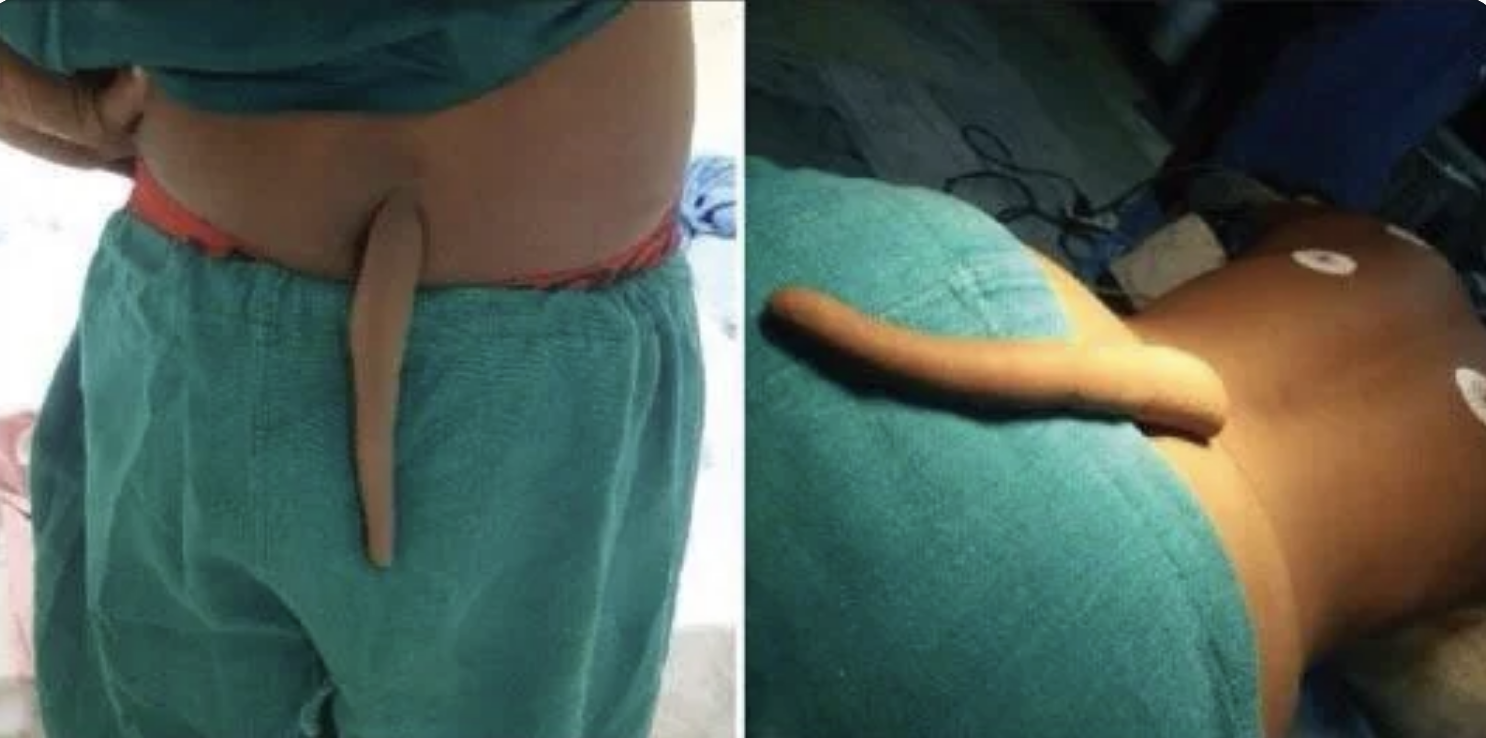 A medical condition resulting in a visible tail-like appendage on the lower back of a child, displayed in two images showing different angles