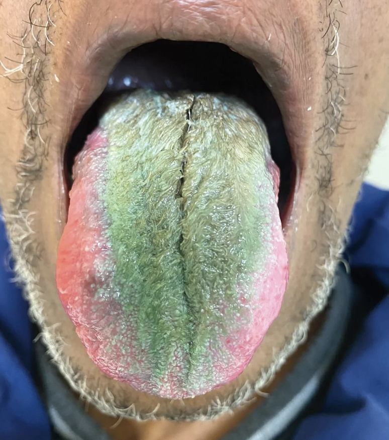 A close-up of a person with a fungal infection on their tongue, showing a characteristic green and red discoloration