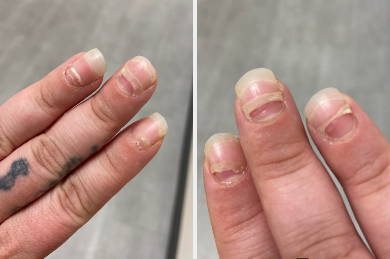 Two images of hands with damaged nails, showing brittle and peeling fingernails