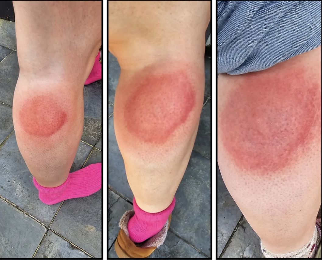 Three side-by-side images showing close-ups of a swollen, red rash on a person&#x27;s knees. The rash appears to be irritated or inflamed