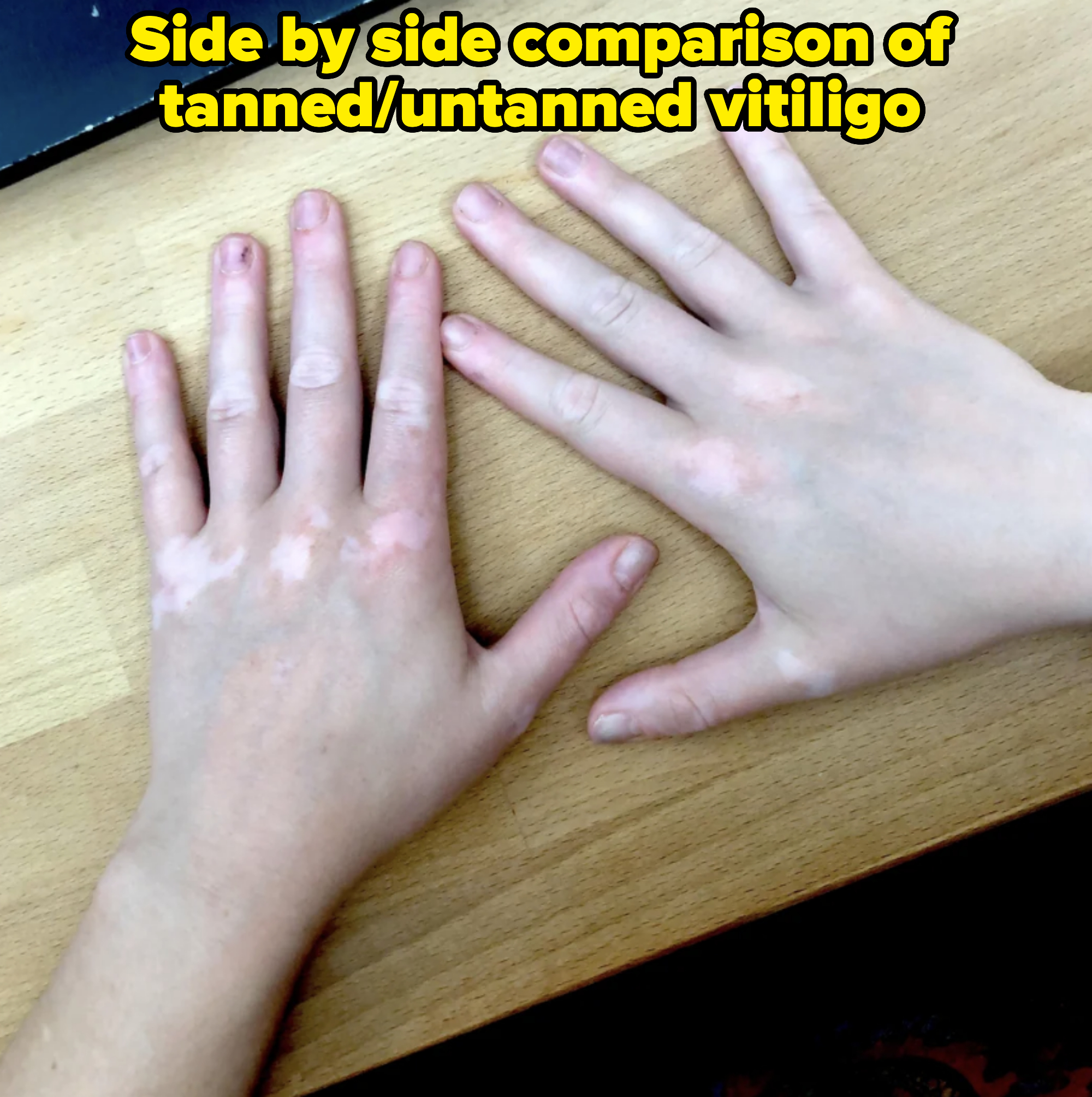 Two hands with vitiligo skin condition, showing areas of depigmentation on a wooden surface