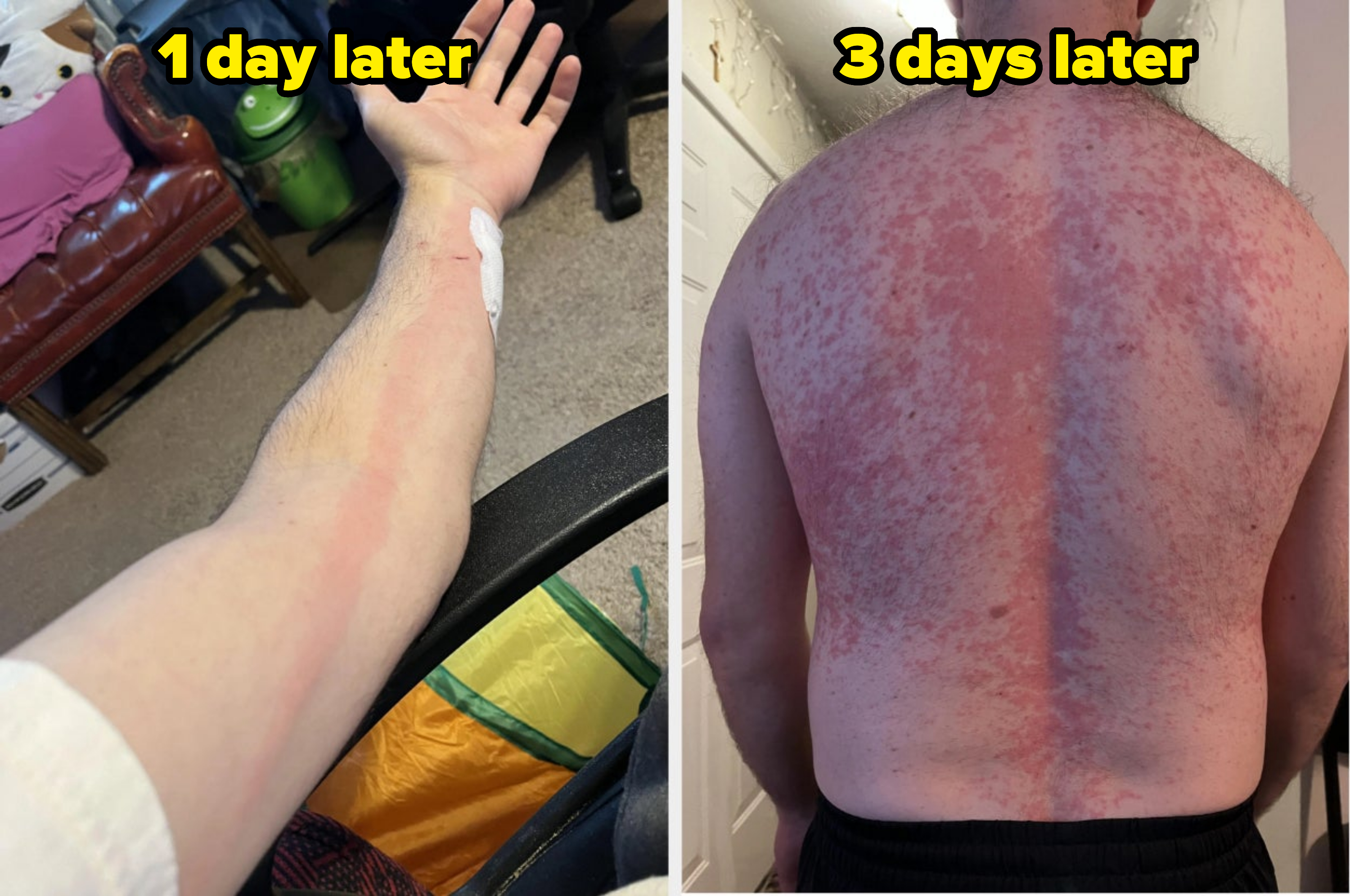 A person shows an arm and back with extensive rash and redness, possibly from a medical condition. The arm has a bandage on the elbow.

