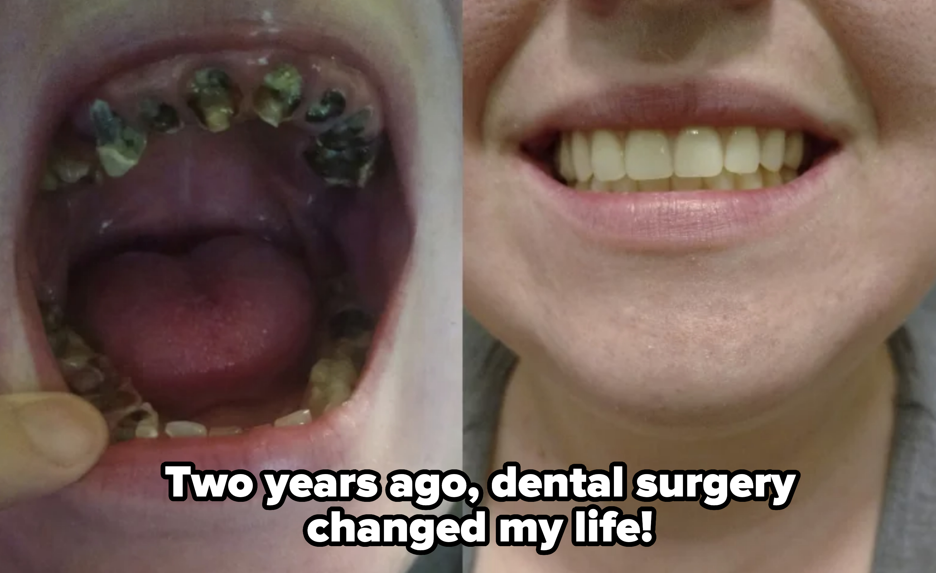 Side-by-side photo: left shows severely decayed teeth, right shows a person smiling with healthy, white teeth. No person names visible