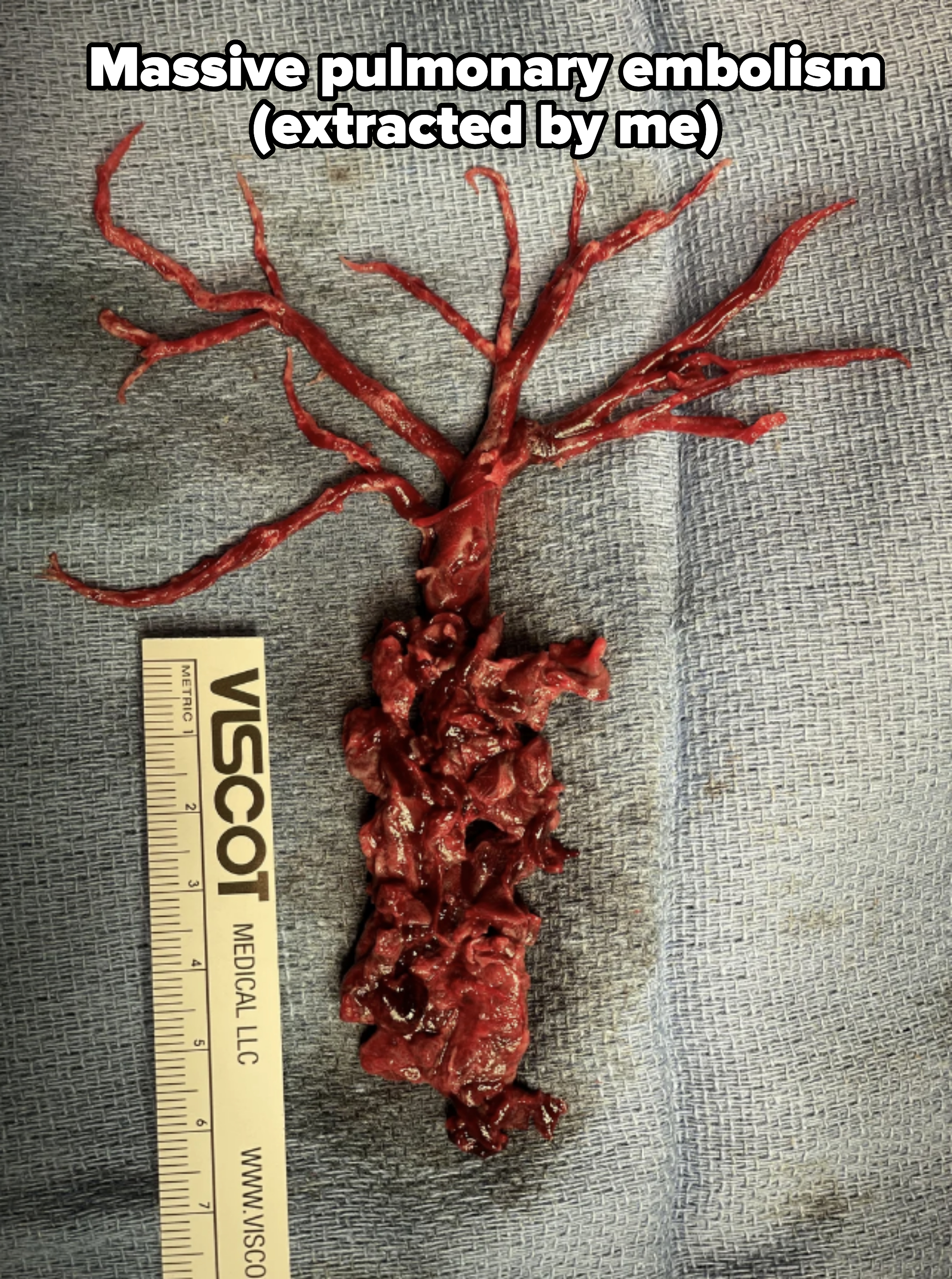 Medical specimen resembling a tree with branching structures, placed on a cloth next to a ruler from Viscot Medical LLC