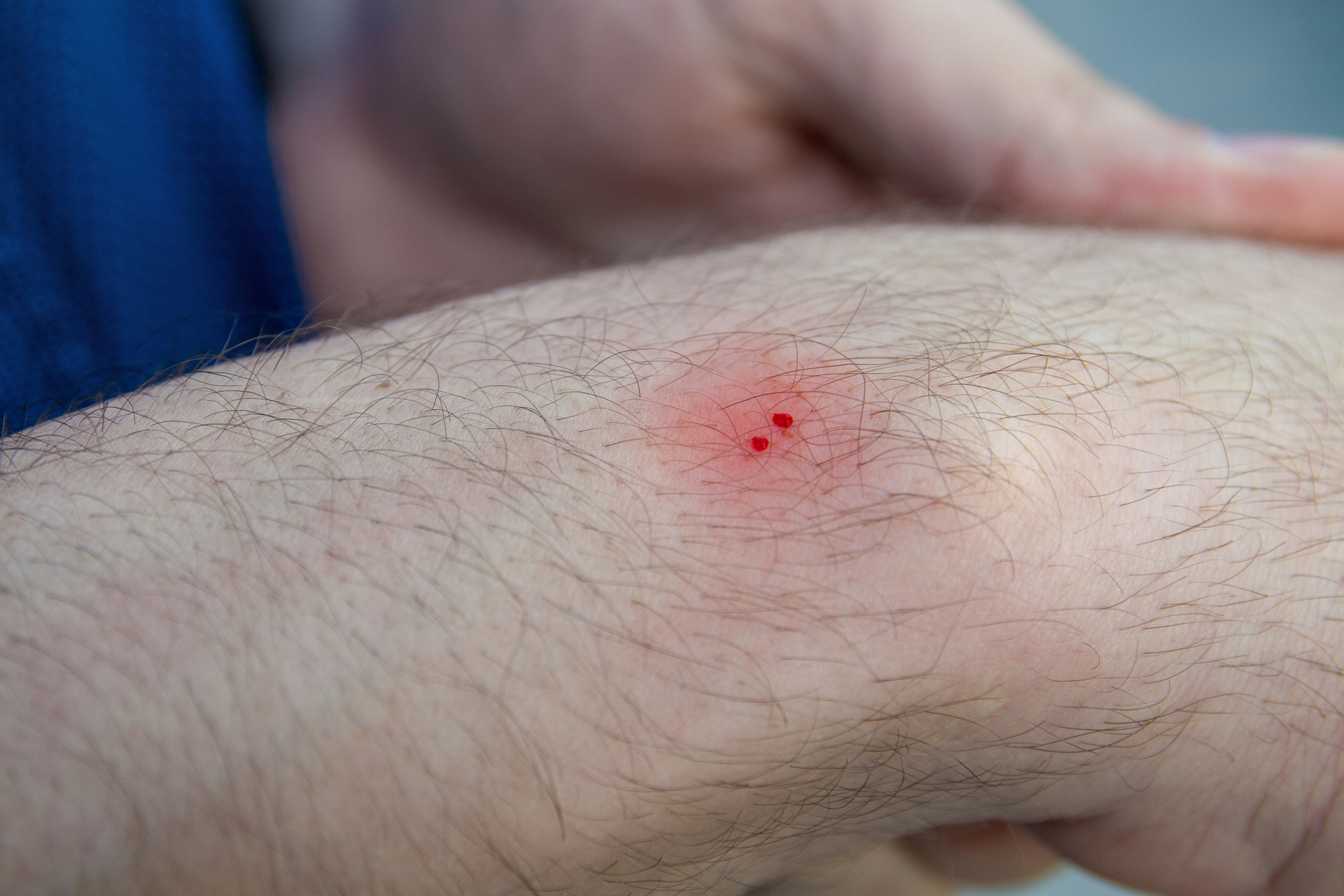 Close-up of an arm with two small red dots in the center of a slightly swollen area, resembling an insect bite