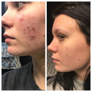 A reviewer's before and after photo which shows her skin much clearer and brighter