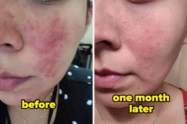 Close-up before and after comparison of a person's skin showing acne treatment results over one month