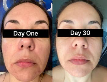 Side-by-side comparison of reviewer's face 30 days apart showing skin improvement from mask