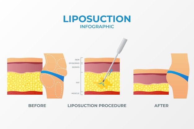 Bezpłatny plik Wektor infografika gradientowej liposukcji