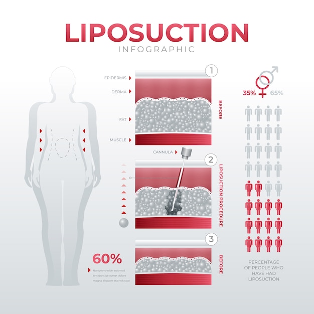 Bezpłatny plik Wektor infografika gradientowej liposukcji