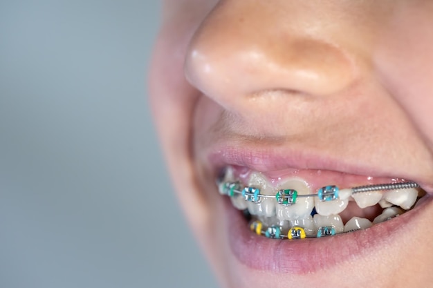 Foto grátis adolescente com aparelho nos dentes closeup de um sorriso