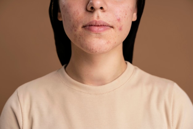 Foto grátis mulher jovem confiante com um close de acne