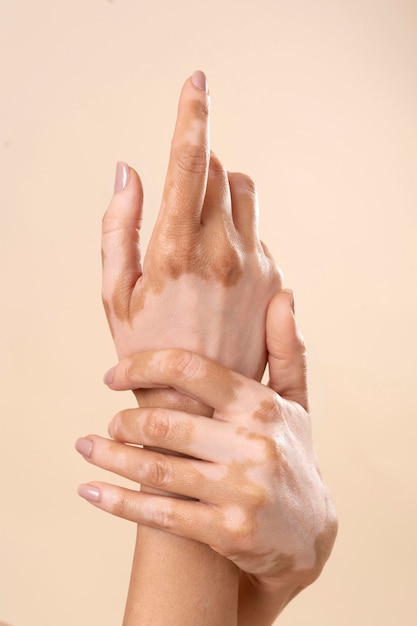 Foto grátis mulher jovem mostrando partes da pele com vitiligo