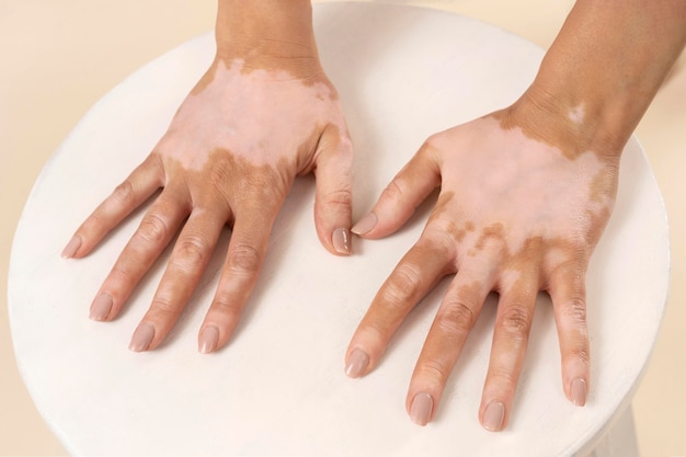 Foto grátis mulher jovem mostrando partes da pele com vitiligo