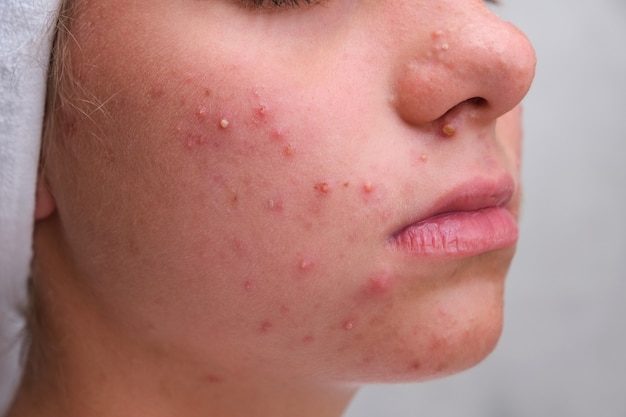 Foto acne. adolescente com espinhas no rosto. pele problemática. fechar-se.