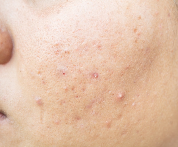 Foto cicatriz de acne no rosto e problemas de pele e poros em adolescentes