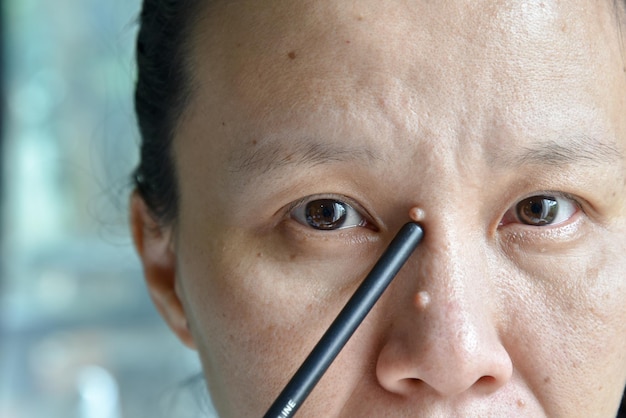 Close-up de uma mulher asiática com verruga no rosto e no nariz, preparada para remover