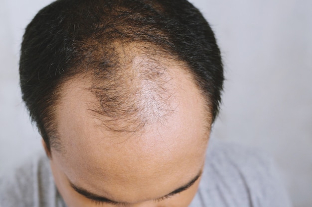 Feche o jovem preocupado com a perda de cabelo grave. cabeça careca fina e couro cabeludo e cabelo quebrado. conceito de saúde