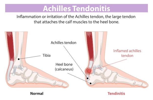 Free Vector achilles tendonitis illustration