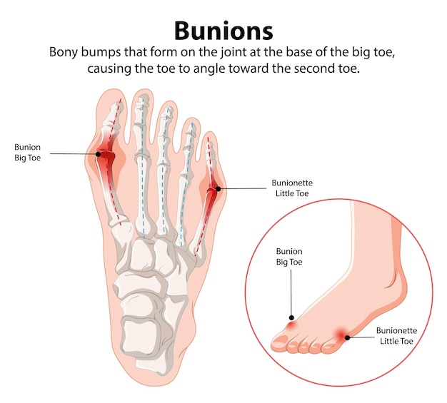 Free Vector bunions and bunionette illustration