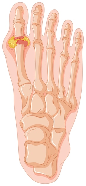 Free Vector diagram showing gout toe