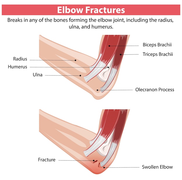 Free Vector elbow fractures illustration