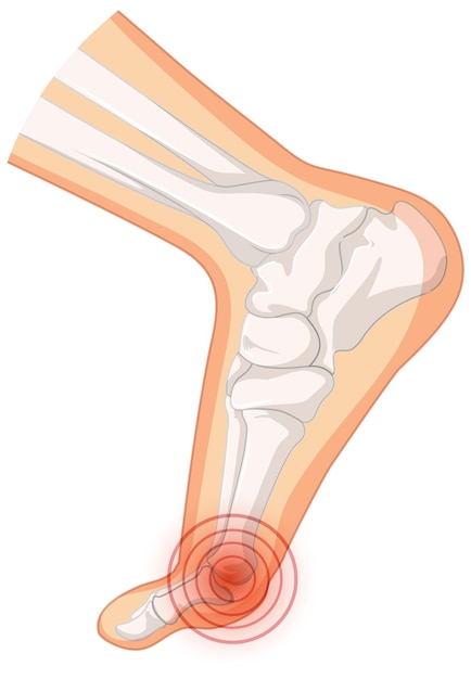 Free Vector hallux valgus types on white background