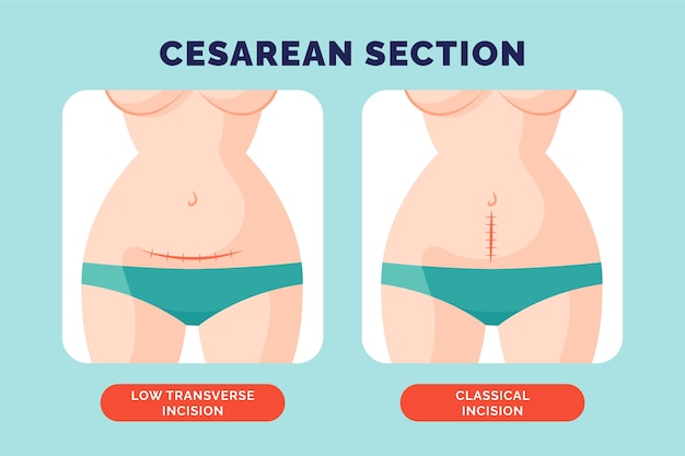 Free Vector hand drawn flat design cesarean section