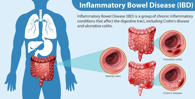 Free Vector inflammatory bowel disease ibd infographic