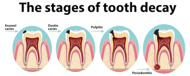 Free Vector infographic of human in the stages of tooth decay