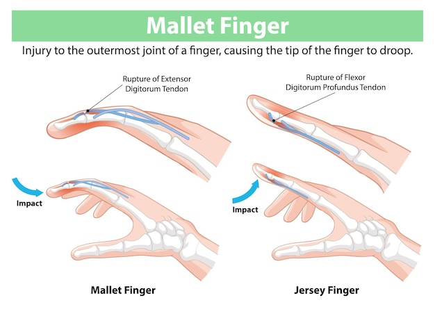 Free Vector mallet finger and jersey finger