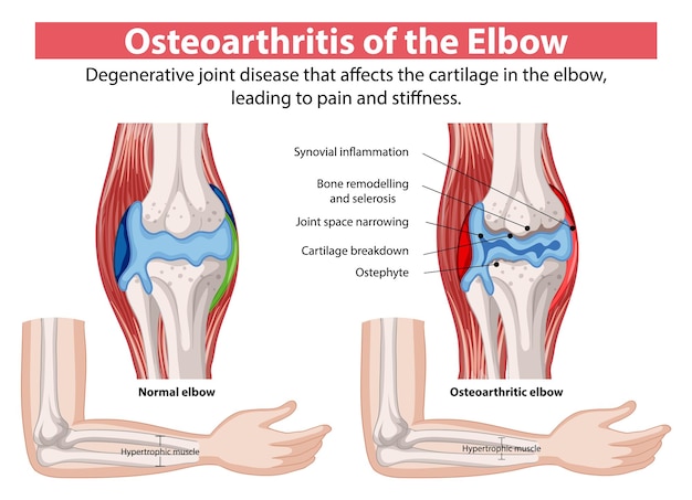 Free Vector osteoarthritis of the elbow