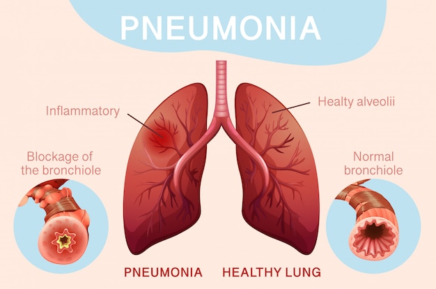 Free Vector poster design for pneumonia with human lungs