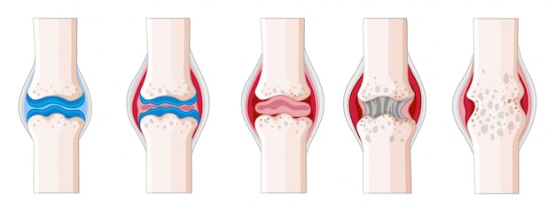 Free Vector rheumatoid arthritis in human body illustration