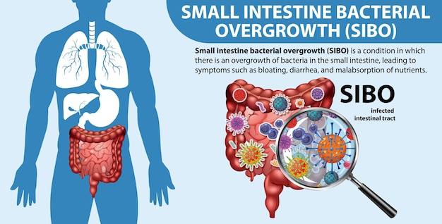 Free Vector small intestine bacterial overgrowth sibo