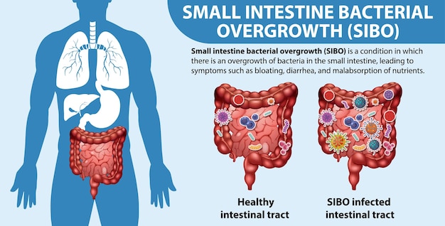 Free Vector small intestine bacterial overgrowth sibo