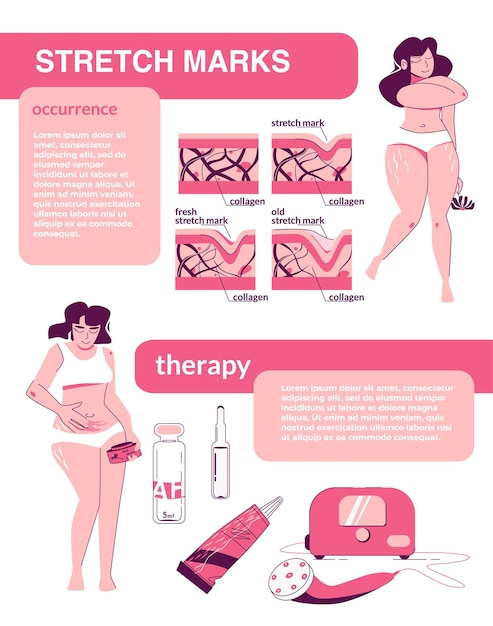 Free Vector stretch marks flat infographic composition with editable text and female characters with skin structure cosmetic products vector illustration