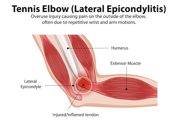 Free Vector tennis elbow anatomy illustration