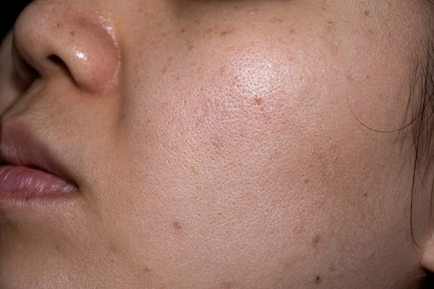 Les femmes au visage en gros plan montrent les taches de rousseur, les taches noires, le bouton du sillon des joues et le teint inégal