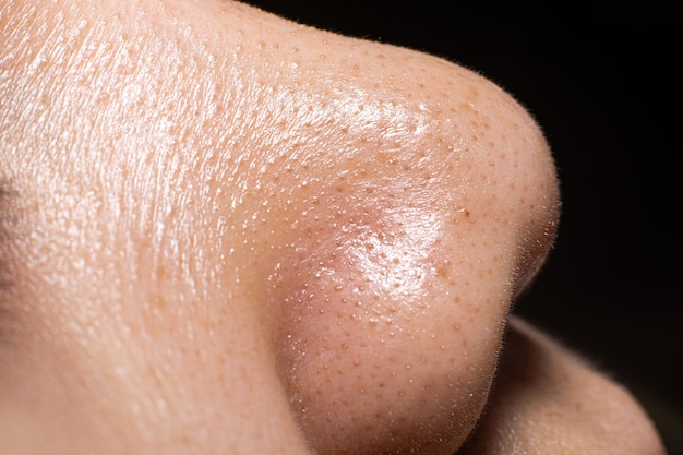 La peau de plan rapproché du nez de femmes montre les petits points noirs de bouton