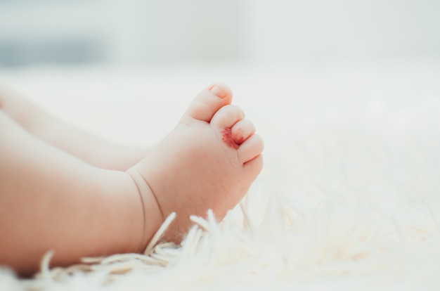 Hemangioma in a girls child on the finger, in a remote place