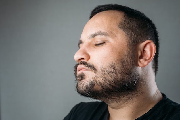 Man with alopecia area in the beard its bad