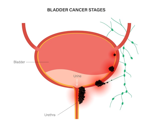 Bladder cancer stages