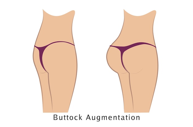 Vector buttock augmentation (gluteoplasty)