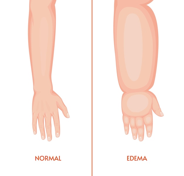 Edema arm Swollen hand fingers wrist forearm