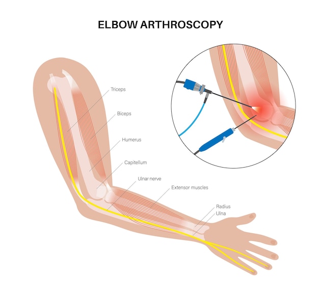 Vector elbow joint minimally invasive surgery arthroscopy medical procedure anatomy of humerus ulna and radius bones arm pain fracture osteoarthritis or rheumatoid arthritis x ray illustration