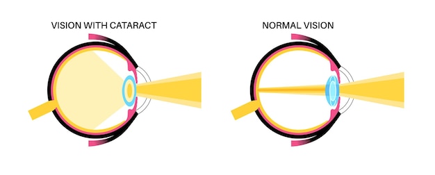 Vector intraocular lenses poster