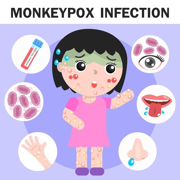 monkeypox infectionmonkeypox symptom in vector